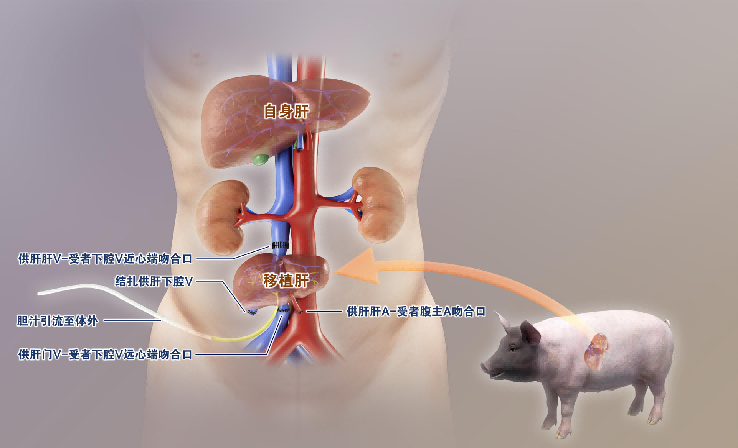 基因编辑猪肝植入人体突破跨物种器官移植壁垒
